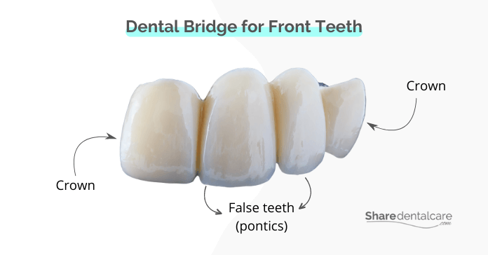 Dental Bridge for Front Teeth