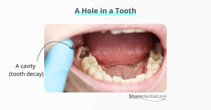 A hole in a tooth (cavity)