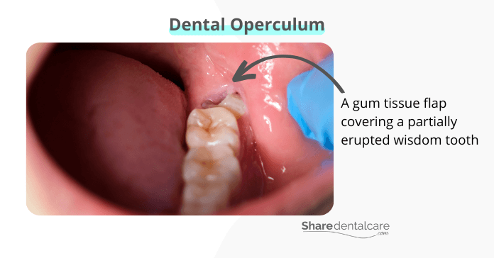 A dental operculum covering a partially erupted wisdom tooth