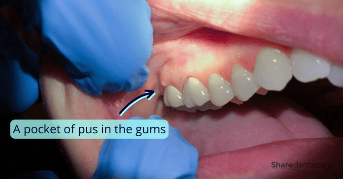 A pocket of pus in the gums