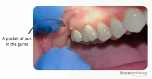 Home Remedies for Gum Abscess - Share Dental Care