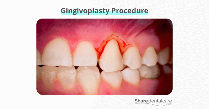 Gingivoplasty procedure to improve the look of gums affected by periodontitis