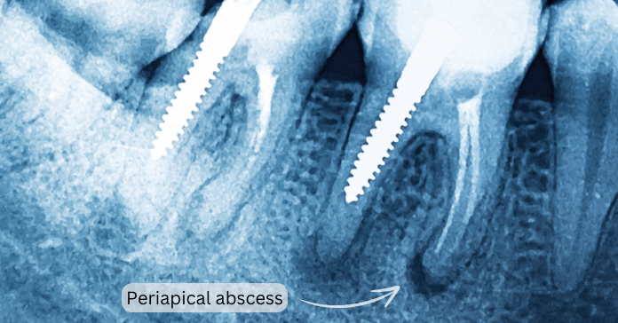 A periapical X-ray showing a dental abscess.