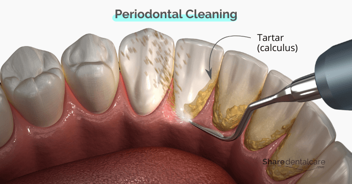 Periodontal cleaning (scaling and root planing)
