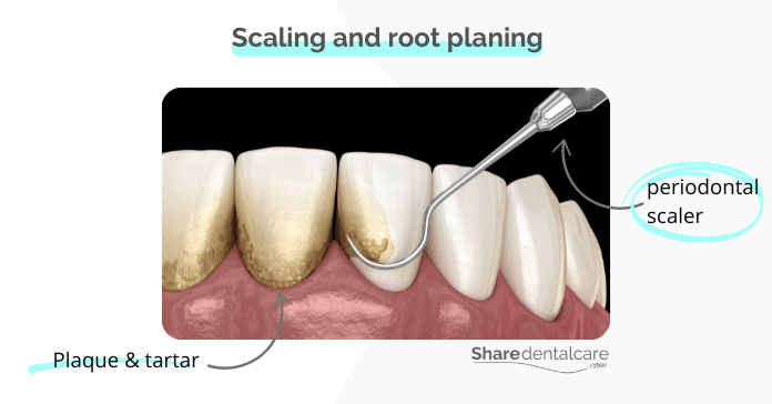 Scaking and root planing procedure