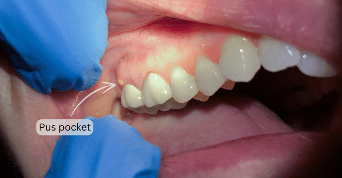 Small pocket of pus in the gum.