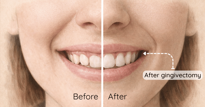 A before and after comparison image shows a smile with excess gum tissue before gingivectomy and a more balanced gum line with visible teeth after the procedure.