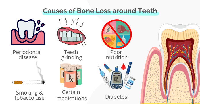 Causes of bone loss around teeth and in jaw