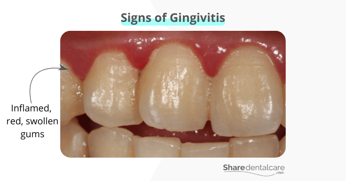 Signs of gingivitis include inflamed, red, and swollen gums