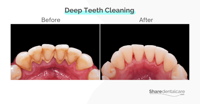 Deep cleaning of teeth performed by a dentist