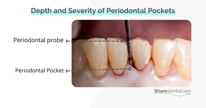 A dentist measures the depth of a periodontal pocket