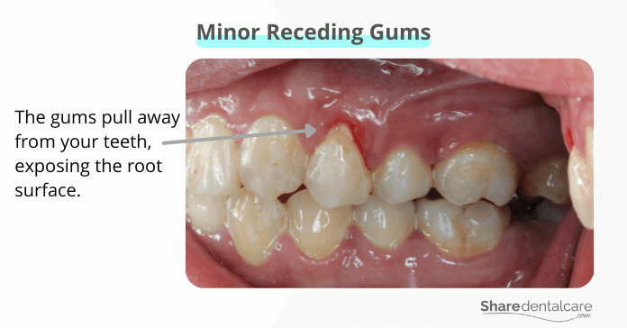 The gums pull away from teeth, causing minor receding gums