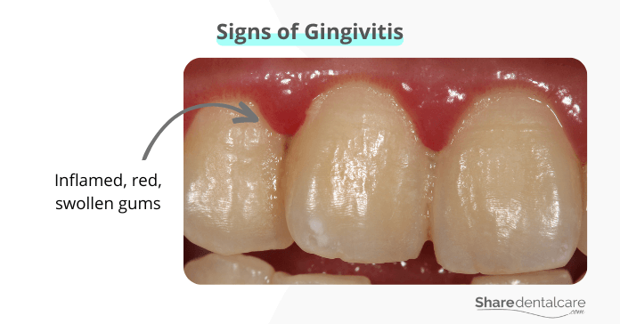 Signs of Gingivitis