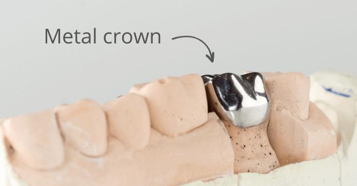 Cast metal dental crown