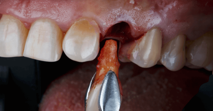 A dentist extracts an upper tooth (canine), leaving an extraction socket behind. 