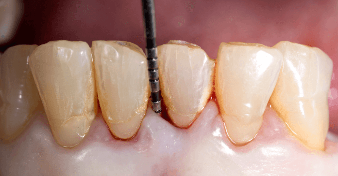 Measuring the depth of a gum pocket with a periodontal probe.