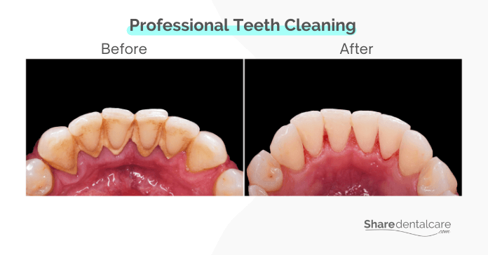 The dentist removes visible tartar from the teeth using specialized tools.