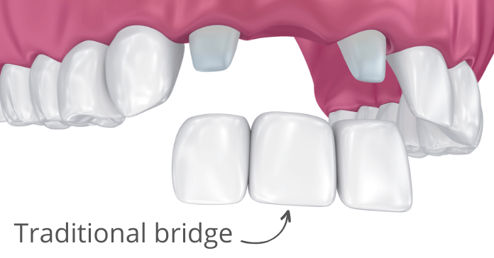 Traditional dental bridge replacing missing front teeth