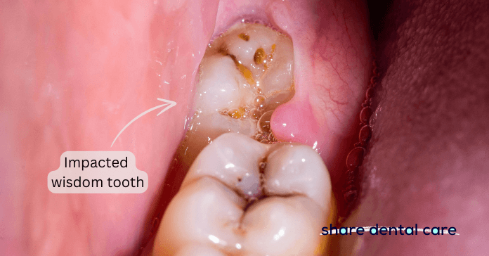 A patient suffers from an impacted wisdom tooth (lower third molar).