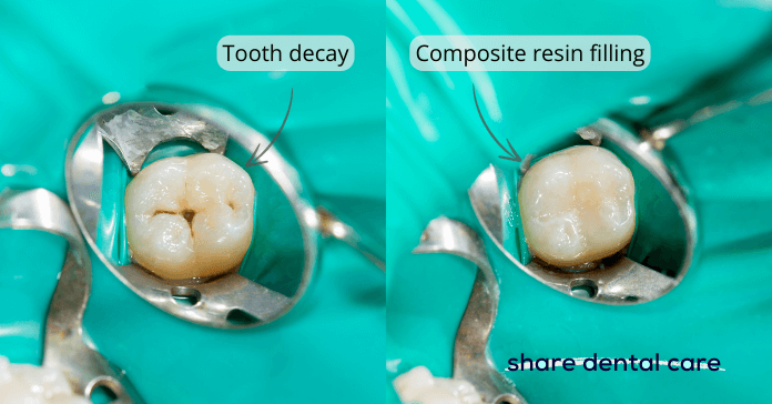 A dentist restores a decayed tooth using white fillings (composite resin).
