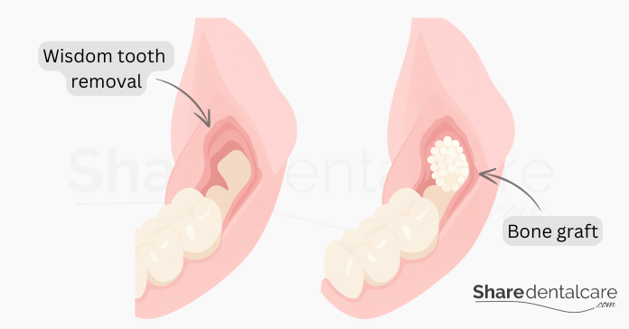 Bone graft after wisdom tooth removal to preserve jawbone density.