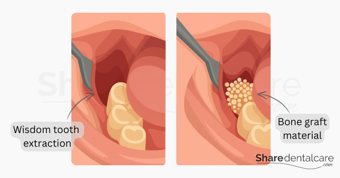 Bone grafting after wisdom tooth extraction showing placement of graft material in the empty socket.