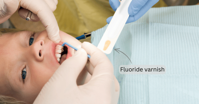 Dentist applies fluoride varnish for children to protect teeth from decay.
