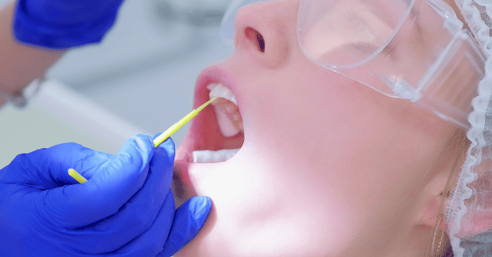 Dentist applies fluoride varnish on adult teeth to strengthen enamel and prevent decay.