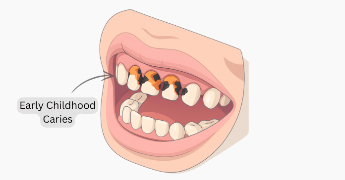 Early Childhood Caries Understanding ECC And Its Risk Factors Share Early Childhood Caries Understanding ECC And Its Risk Factors Share