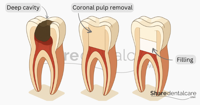 Illustration of pulpotomy procedure showing deep cavity, coronal pulp removal, and tooth filling.