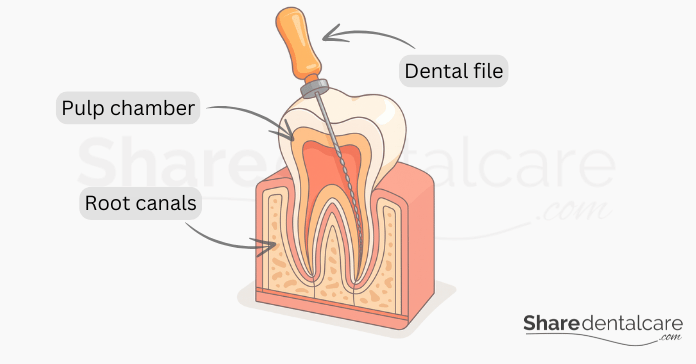 Root Canalling Root Canal with Crown: What to Expect with This Dental Treatment ...