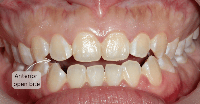 Open Bite What Causes This Malocclusion And How To Fix It Share Open Bite What Causes This Malocclusion And How To Fix It Share