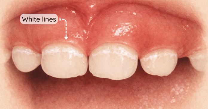 White chalky lines appear along the gumline of primary teeth and indicate early enamel damage linked to baby bottle caries.