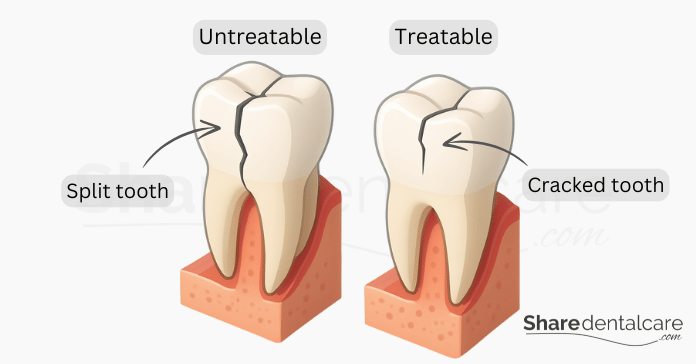 Tooth Split In Half Vertically Root Canal for Cracked Tooth: Can a Damaged Tooth Be Saved? - Share ...