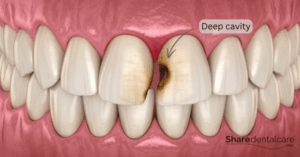 Root Canal on Front Tooth: Will It Hurt — and Look Natural After ...