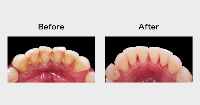 Before and after dental tartar removal showing clean teeth after professional cleaning.