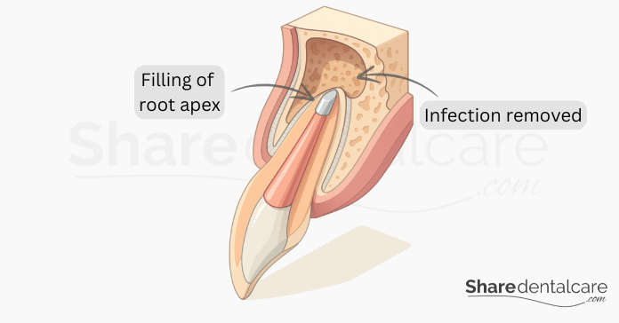 Endodontic surgery apicoectomy showing root apex filling and infection removal.