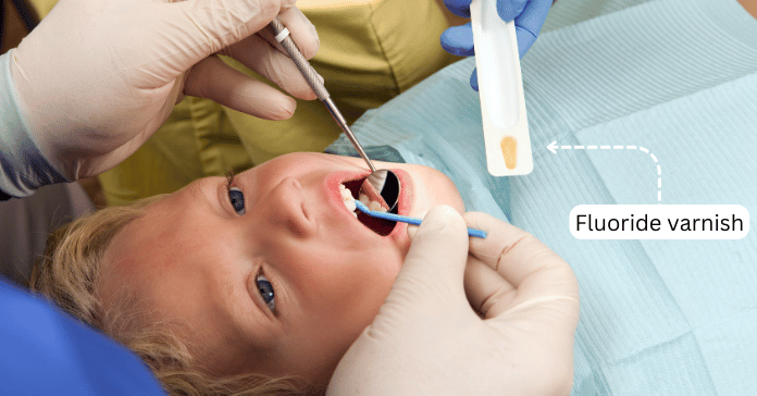 Child receiving fluoride varnish treatment at the dentist to prevent cavities.