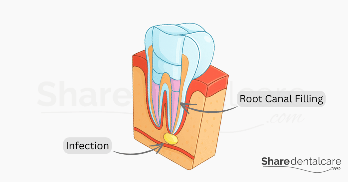Root Canal Retreatment: When Endodontic Retreatment Is Needed - Share ...