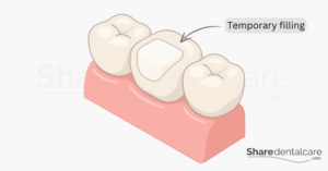 Root Canal Filling Fell Out: What You Should Do Immediately? - Share ...