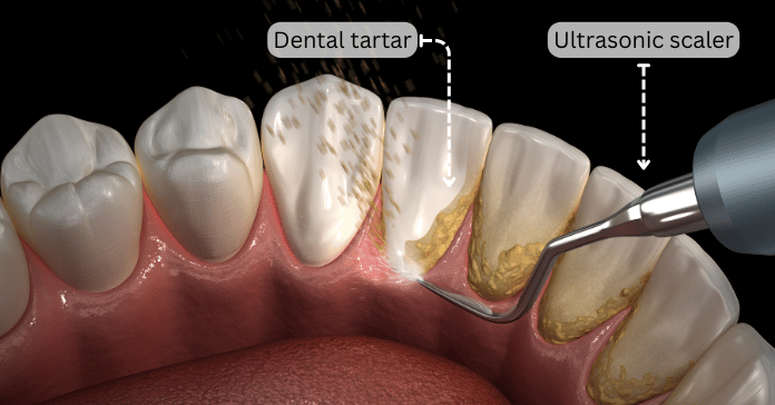 Dental Tartar Removal Best Ways To Remove Tartar From Teeth Share 