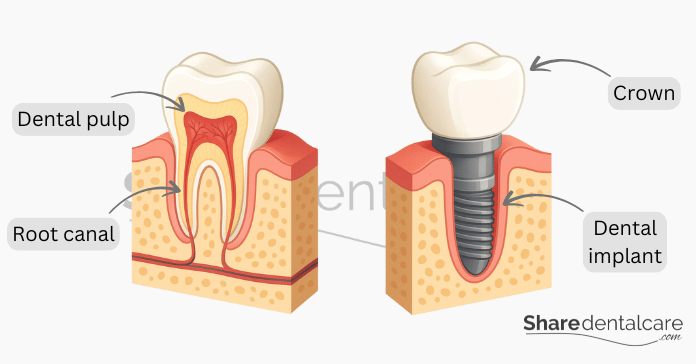 Illustration showing root canal treatment with dental pulp and dental implant with crown.