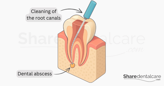 Illustration of root canal treatment showing cleaning of the root canals and removal of dental abscess
