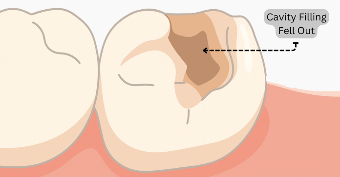 Cavity Filling Fell Out: Why Tooth Fillings Fall Out and What to Do