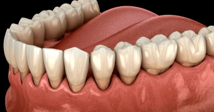 3D illustration showing gum recession caused by advanced periodontitis.