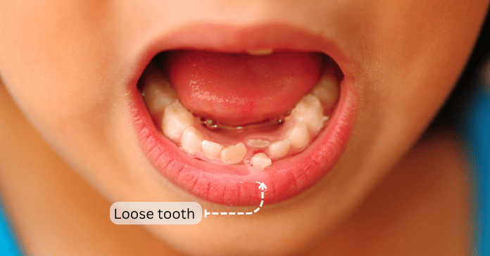 Close-up of a child with a loose tooth in the lower jaw.