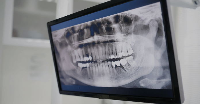 Panoramic dental X-ray showing bone loss and gum disease around teeth.