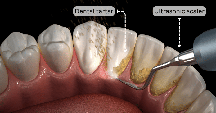 Scaling to remove black tartar from teeth using an ultrasonic scaler.