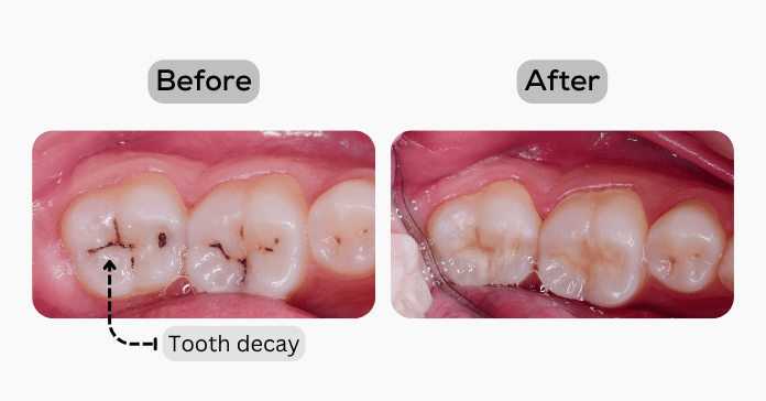 Before and after image showing tooth decay treated with a dental filling.