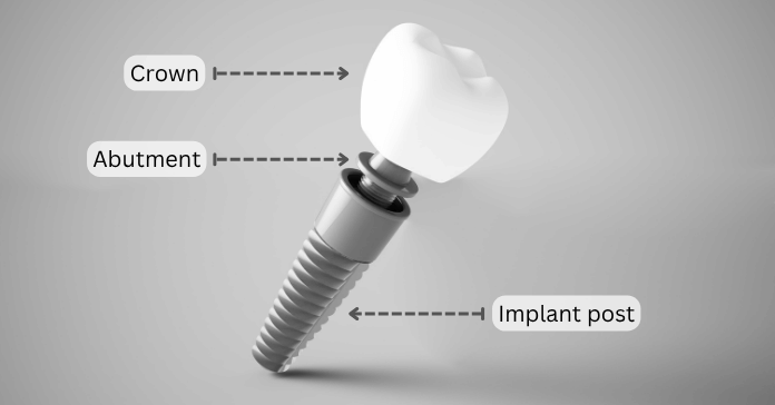 Diagram showing dental implant parts including crown, abutment, and implant post.